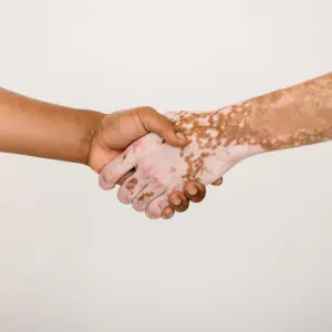 Psoriasis: la importancia de un diagnóstico temprano para evitar complicaciones graves