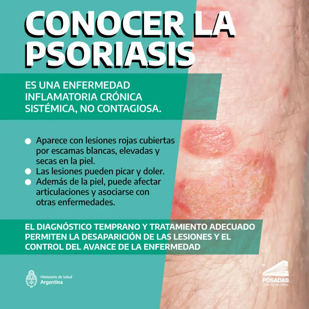 Psoriasis