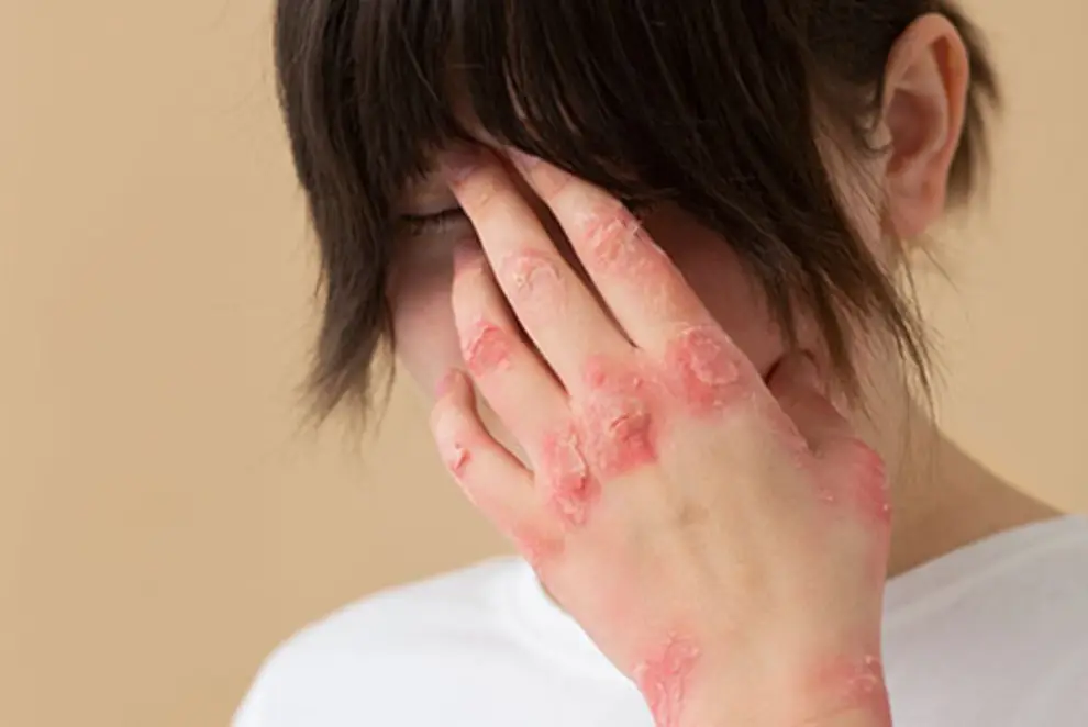 Psoriasis