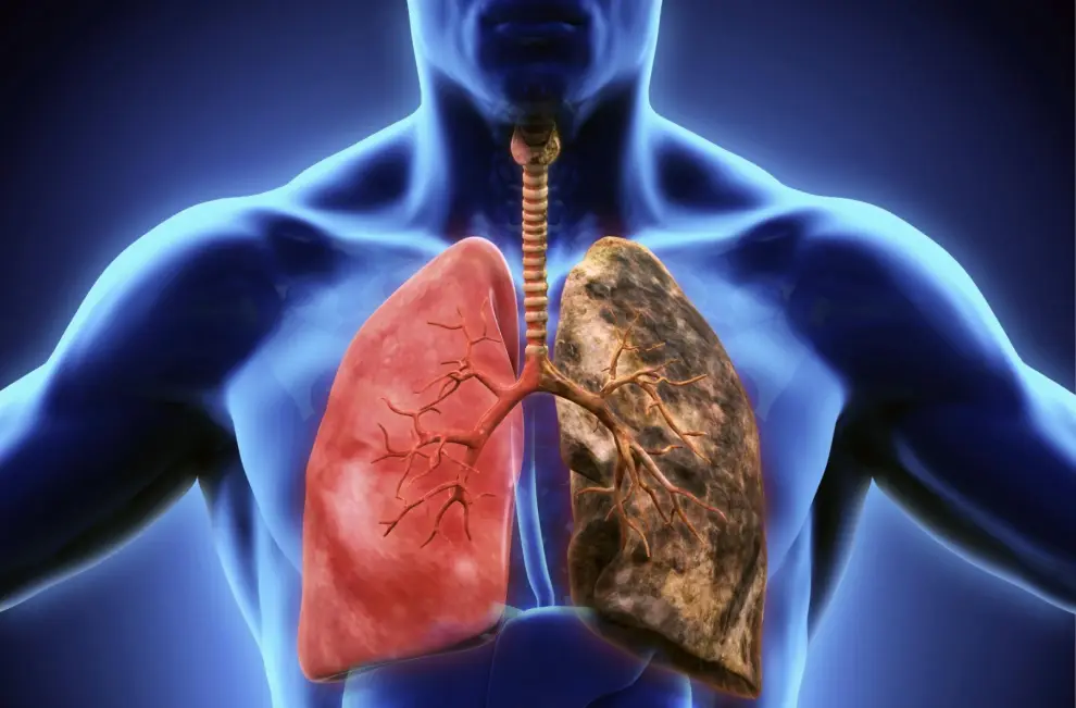 El cáncer de pulmón mata a 10 mil personas por año en la Argentina