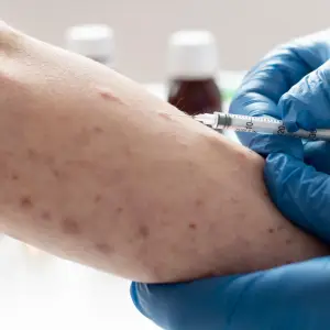 Alerta sanitaria por cuatro casos de sarampión confirmados en viajeros que pasaron por Salta
