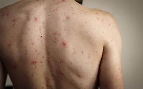 El sarampión es una enfermedad viral altamente contagiosa