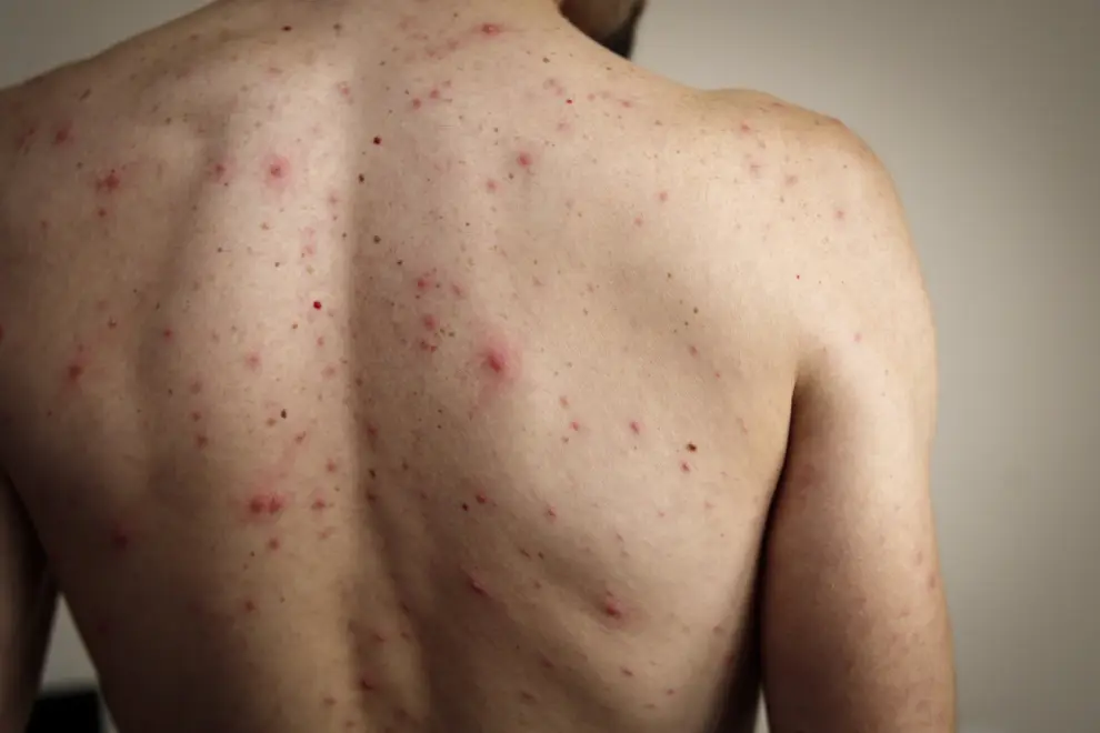 El sarampión es una enfermedad viral altamente contagiosa