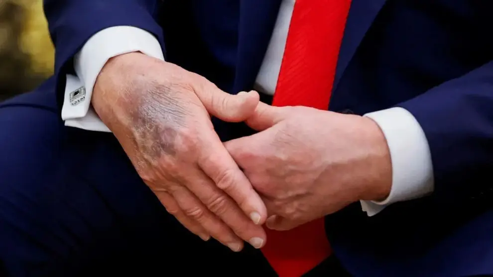 El propio Trump y su médico insisten en que su salud es excelente, pese a los hematomas en sus manos