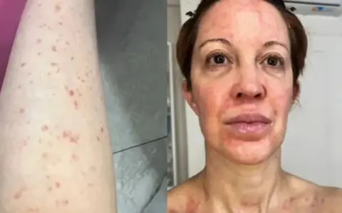 Miriam Lanzoni, habló sobre la enfermedad que padece