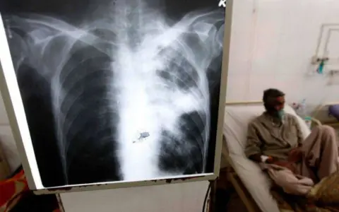 Tuberculosis
