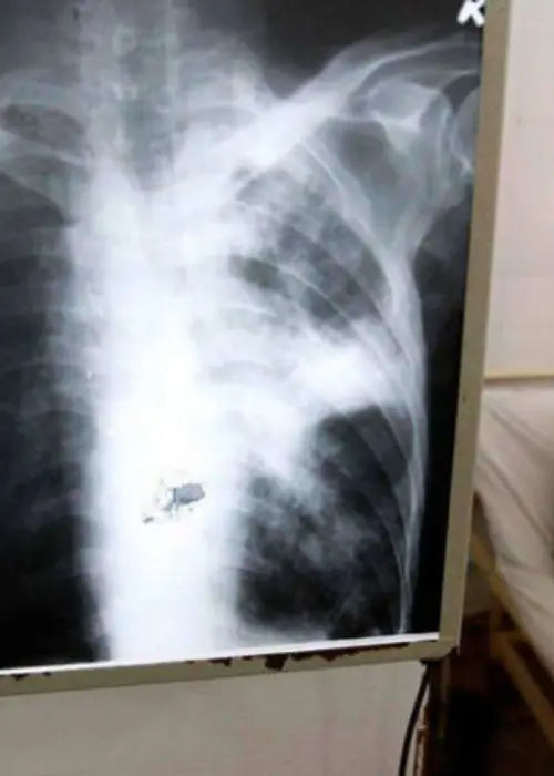 Tuberculosis