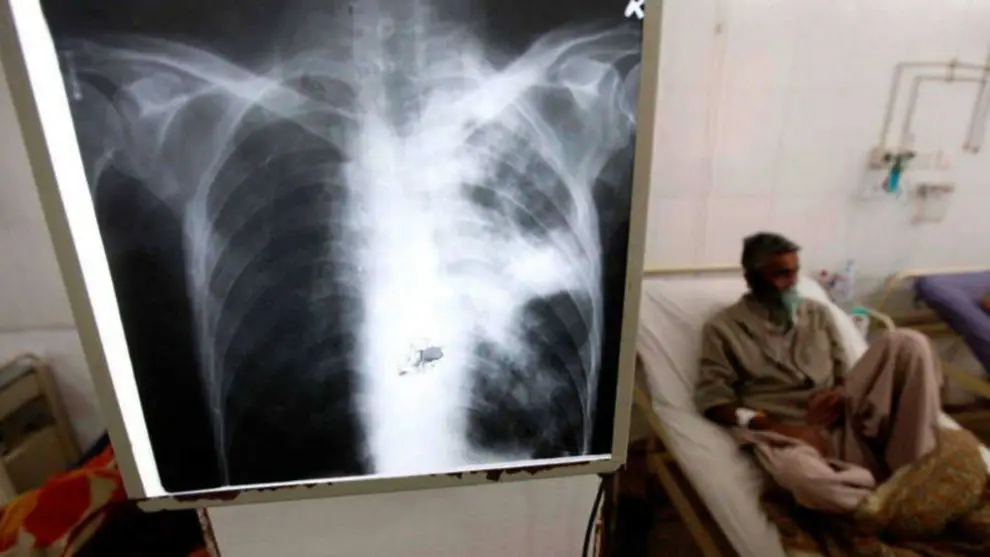 Tuberculosis