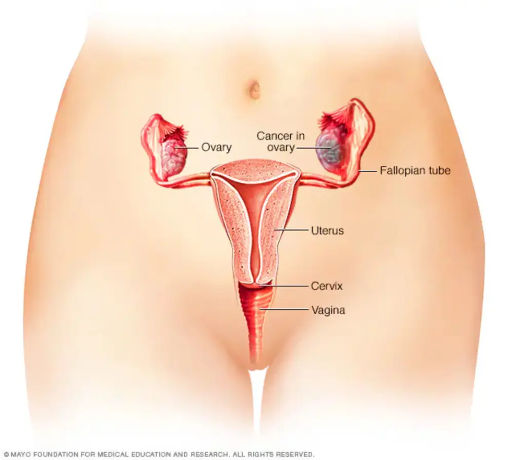 Cáncer de ovarios