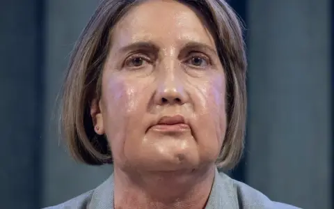 Carme, la paciente española trasplantada.