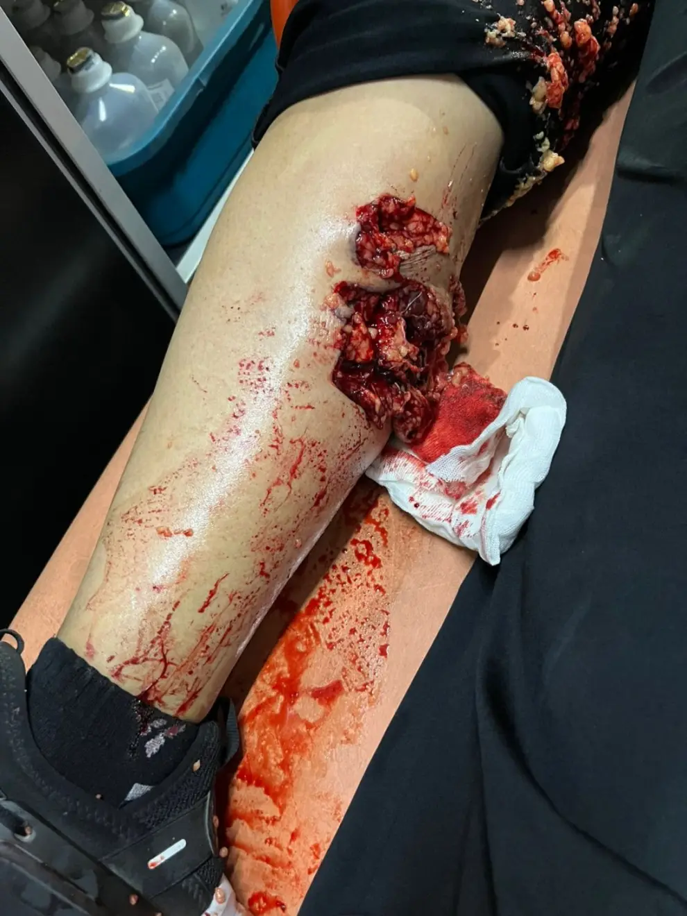 Imágenes del estado de la pierna de la víctima la misma noche del incidente.