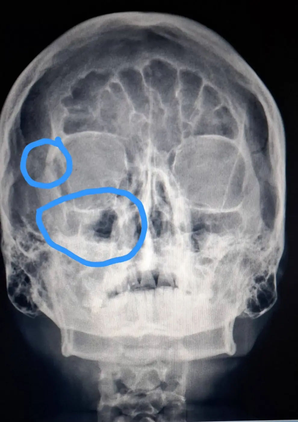 La radiografía de cráneo de Olazo