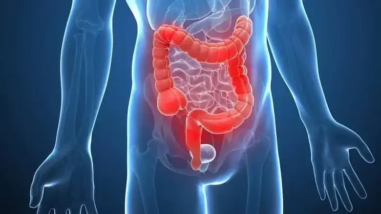 cancer de colon