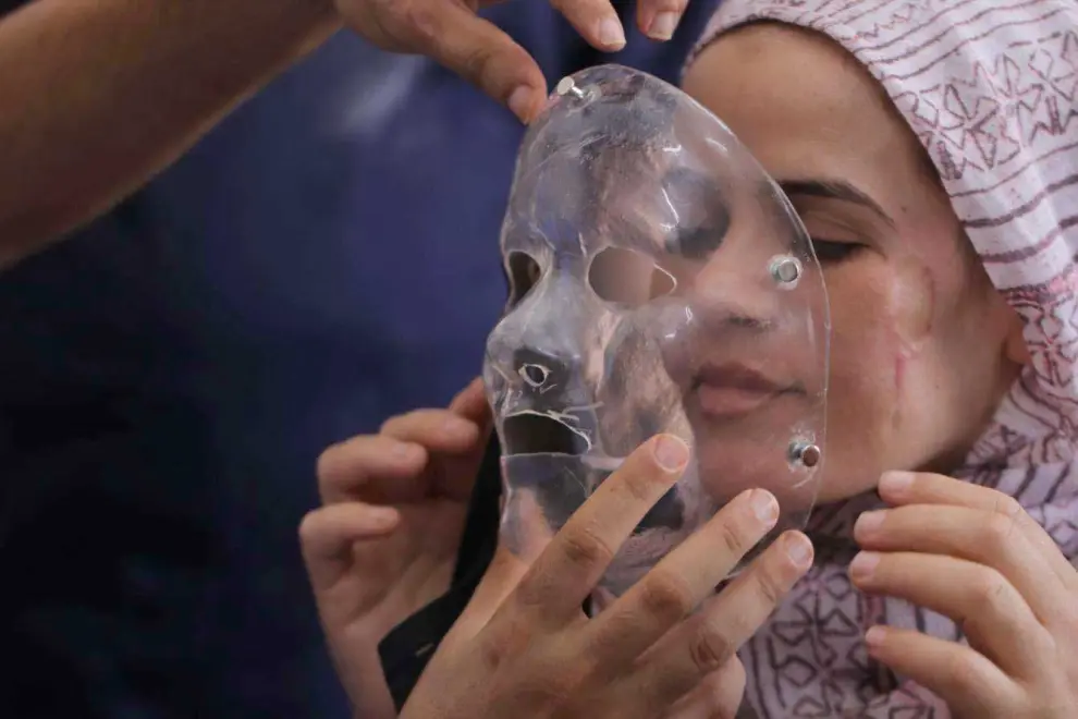Máscaras impresas en 3D devuelven esperanza a niños con graves quemaduras en Gaza.