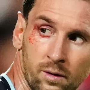 A Messi no solo se le cortó el ojo en el partido contra Suiza