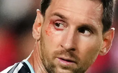 Messi y su ojo
