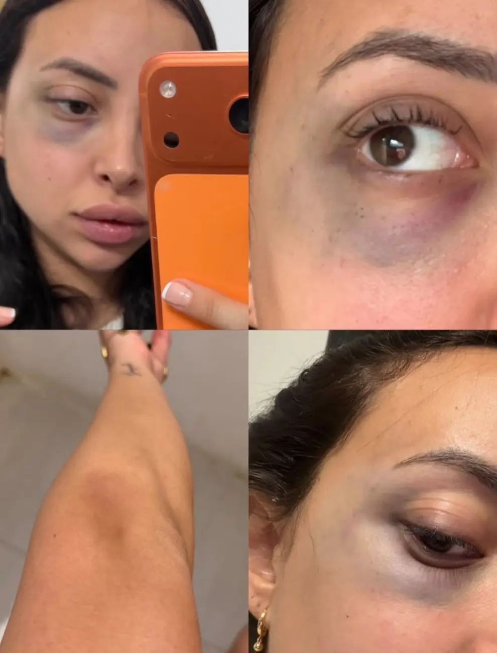 Las fotos con moretones en el rostro que hizo públicas la denunciante.